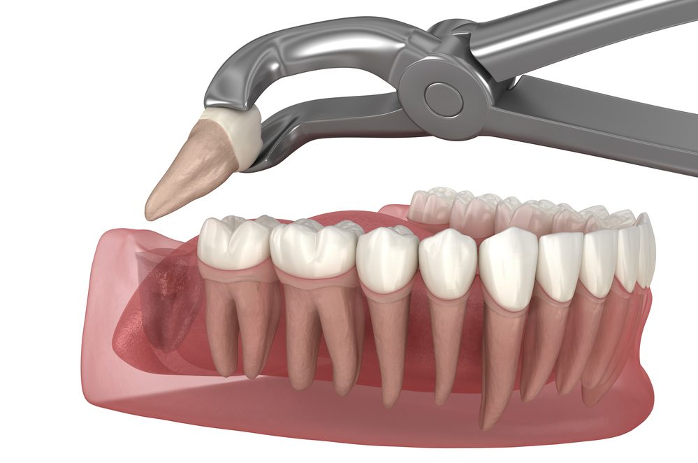Wisdom Teeth & Wise Profits: The Business Side of Surgical Extractions